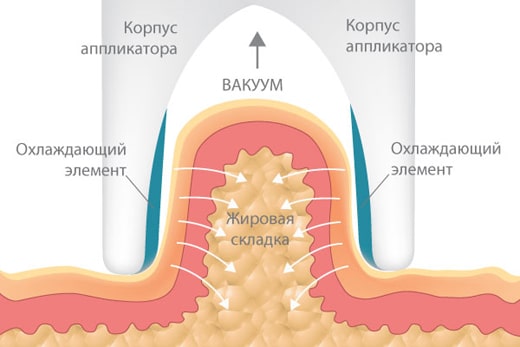 Механизм действия криолиполиза