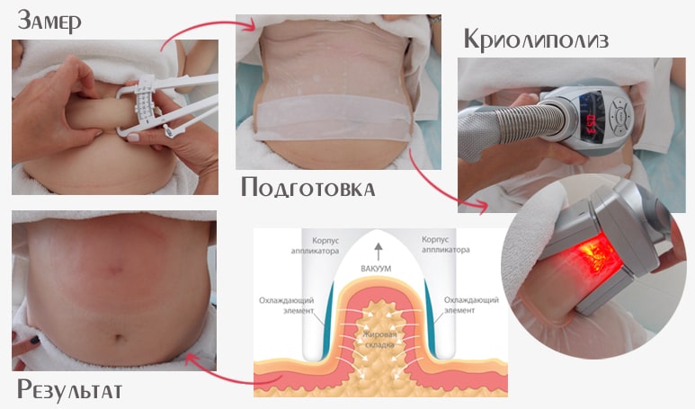 Подготовка к криолиполизу