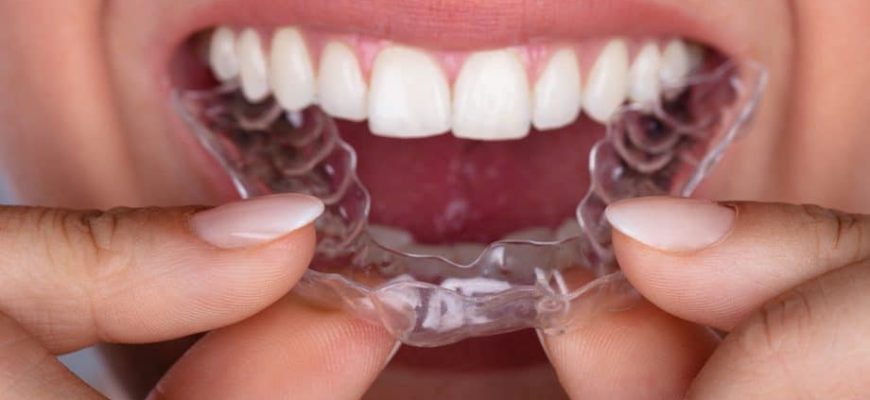 елайнери для зубів 1